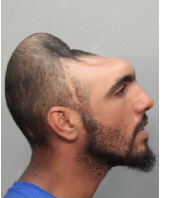 Man with half his head